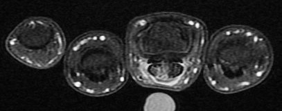 Figure 2 for case gout arthritis ( RID3567 )